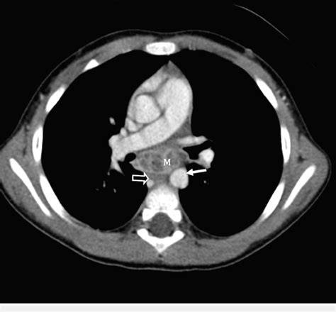 Axial post contrast CT of mediastinal mass Axial post contrast CT image... | Download Scientific ...