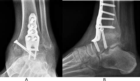 Deep peroneal neuropathy diagnosed by musculoskeletal ultrasound after ankle arthrodesis with an ...