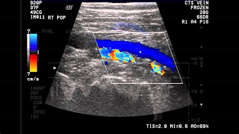 Vascular Ultrasound Of Legs