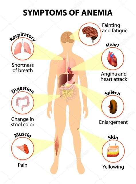 Symptoms of anemia — Stock Vector © edesignua #67274427