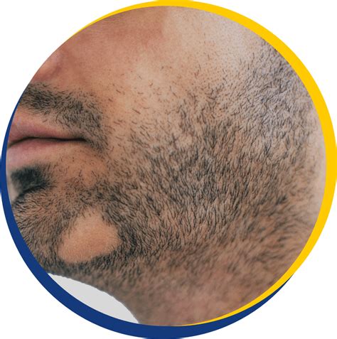 Facial Hair (Beard) Loss - The Knudsen Clinic