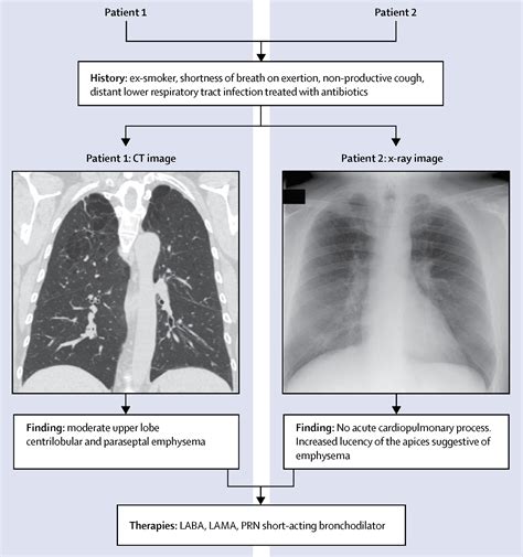 Copd Ct Scan Findings