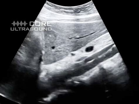 Aortic Dissection Ultrasound