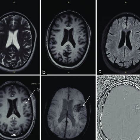 MRI volumetric measurement of right dorsolateral prefrontal cortex ...