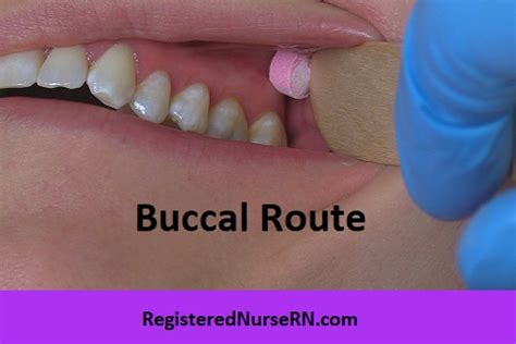 Buccal Medication Administration Route Nursing Skill