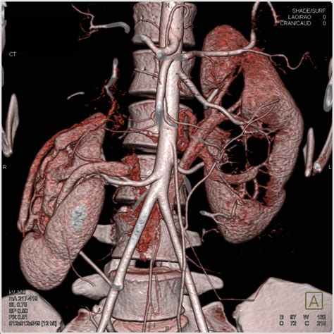 Unusual case with Malrotated Right Kidney and Dilated Calyceas Left ...