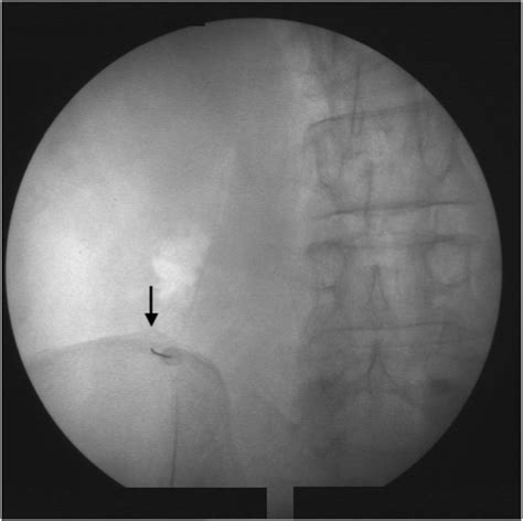 Evaluation of the efficacy of Superior Cluneal Nerve Block in low back pain: A prospective ...