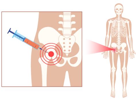 Intra-Articular Steroid/Lidocaine Injection Improves Hip Arthritis Pain ...