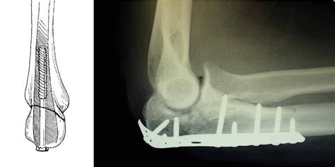 Elbow (Olecranon) Fracture Treatment | Boston Medical Center