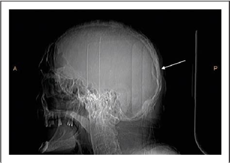 Depressed Fracture X Ray