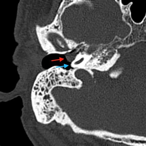 Glomus tympanicum paraganglioma - most common middle ear tumor, more than 40 years - arise from ...