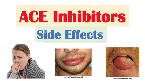 ACE Inhibitor Side Effects: Lisinopril, Ramipril, Captopril, Perindopril | Causes and Why They ...