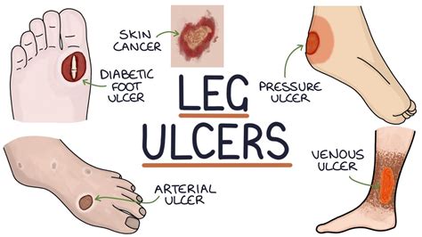 Skin Ulcers: Types, Symptoms, Causes, And Treatment, 45% OFF