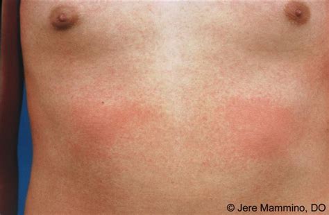 Scarlet Fever - American Osteopathic College of Dermatology (AOCD)