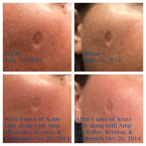 Pock marks before and after | Rodan and Fields Before and Afters | Pinterest | Amp md roller and ...