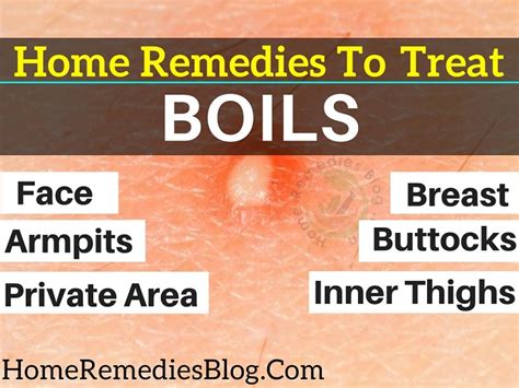 Home Remedies for Boils: 11 Ways to Treat Boils Naturally - Home Remedies Blog