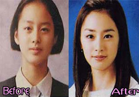 Kim Tae Hee Plastic Surgery Before And After Face Photos