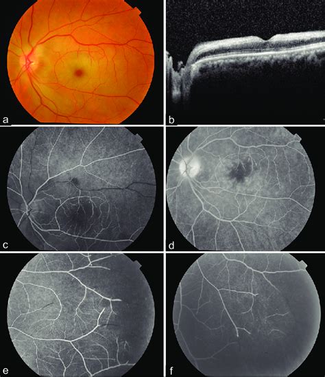 (a) Fundus photograph of the left eye shows a cherry-red spot at the... | Download Scientific ...