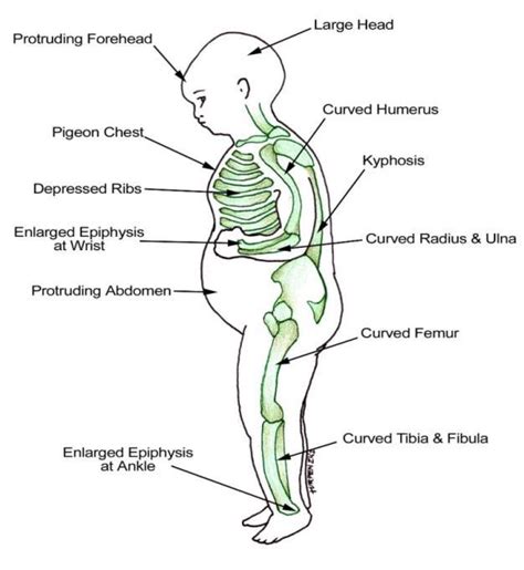 The figure presents Signs and symptoms of rickets. 3.5 HOW TO APPROACH... | Download Scientific ...