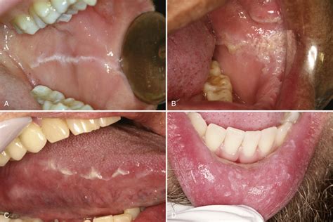 Reactive Keratotic Lesions (Nonleukoplakias) | Pocket Dentistry