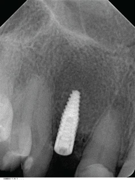 Dental X-ray after dental implantation. | Download Scientific Diagram