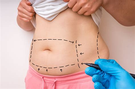 A Short Guide for Tummy Tuck/Liposuction in Mexico - The Aspiring Gentleman