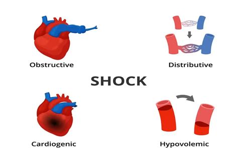 Cardiogenic Shock: A Comprehensive Overview - Longmore Clinic