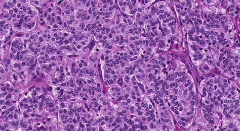 Atypical carcinoid tumour (lung) - MyPathologyReport.ca