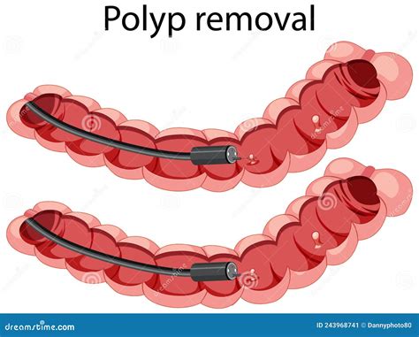 Diagram Showing Polyp Removal Stock Vector - Illustration of treatment, polyp: 243968741