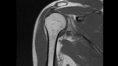 Supraspinatus Rotator Cuff Tear MRI