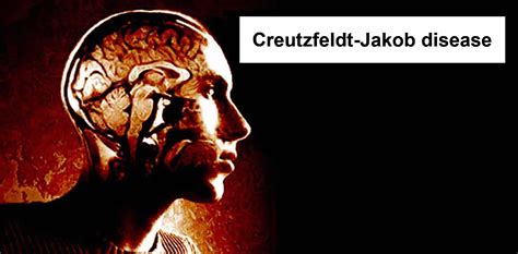 Creutzfeldt-Jakob disease Causes, Symptoms, Diagnosis & Treatment