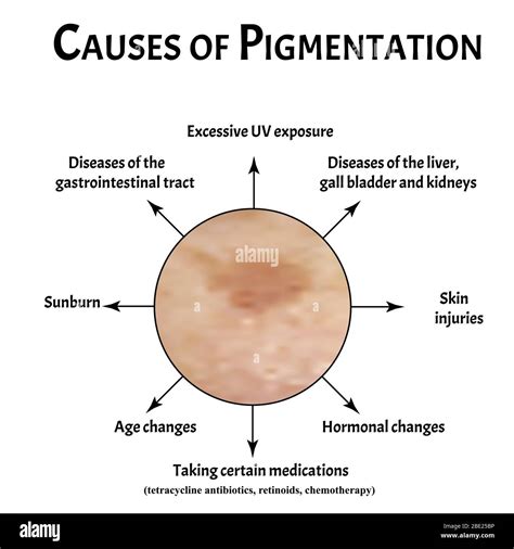 Pigmentation on the skin causes. Brown spots on the skin. Pigmentation ...