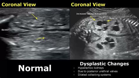 Normal Kidney Ultrasound