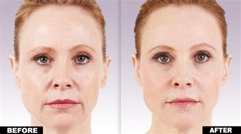 Juvederm (Ultra, Ultra Plus & Voluma) - Horizon Dermatology & Cosmetic Center - Horizon ...