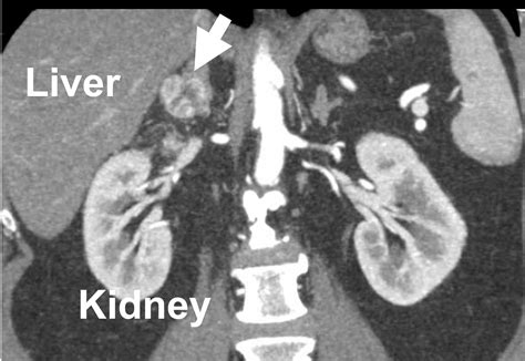 Overview of Adrenal metastasis