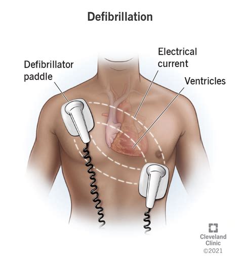 Automated External Defibrillator Pad Placement