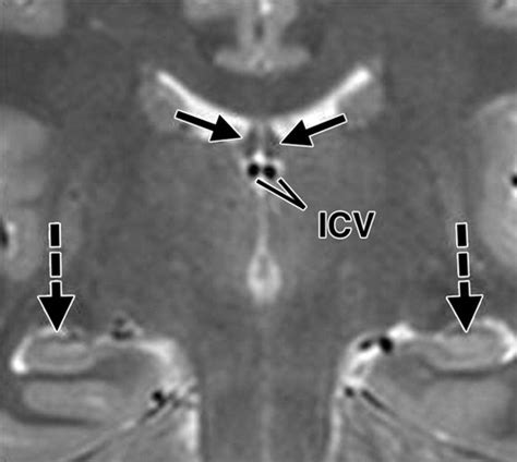 The Fornix in Health and Disease: An Imaging Review | RadioGraphics