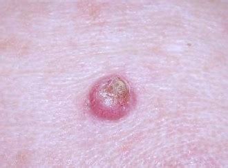 Keratoacanthoma - Pictures, Diagnosis, , Symptoms, Treatment