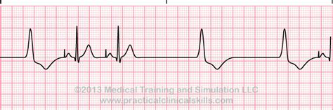 Pacemaker Failure to Pace ECG Interpretation with Sample Strip