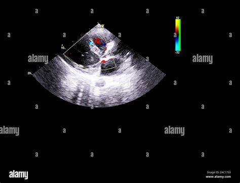 Screen of an ultrasound machine with a heart image Stock Photo - Alamy