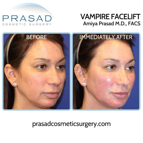 What is a PRP Facial and its Benefits? | Dr. Prasad Blog