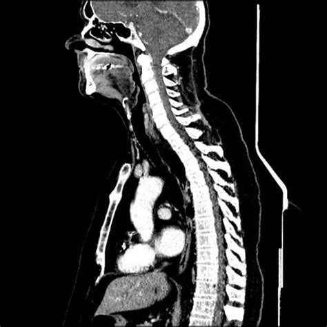 ct airway - democratiz3D® Processing - embodi3D.com