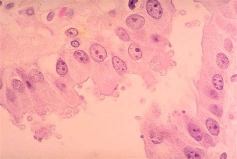 Free picture: histopathology, cryptosporidiosis, gallbladder