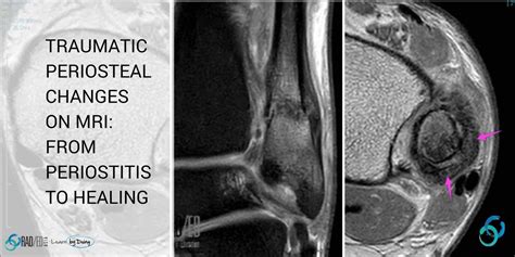 PERIOSTEAL REACTION RADIOLOGY MRI: THE RANGE OF TRAUMATIC PERIOSTEAL CHANGES ON MRI - Radedasia