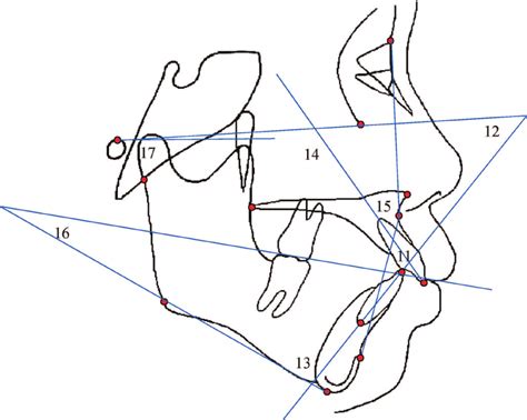 Angular measurements used in study (continued): 11, interincisal angle;... | Download Scientific ...