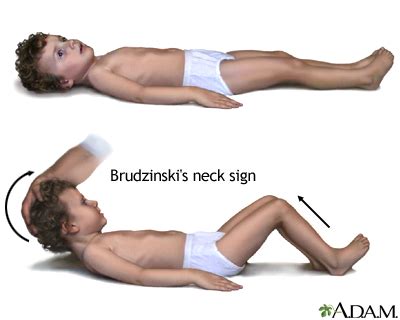 Brudzinski's sign of meningitis: MedlinePlus Medical Encyclopedia Image