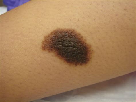 Congenital melanocytic nevus - Dermatology Advisor