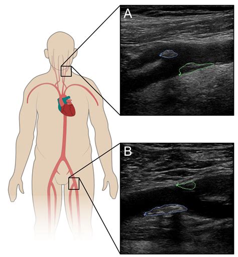 B-mode ultrasound of the carotid bulb and common femoral bifurcation... | Download Scientific ...