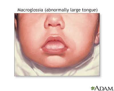 Symptoms of macroglossia - MEDizzy