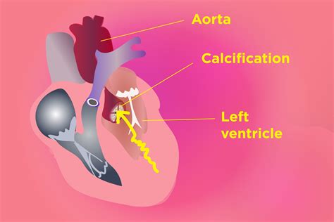 Celecoxib Safety Questioned Yet Again as New Study Finds Link to Heart Valve Calcification